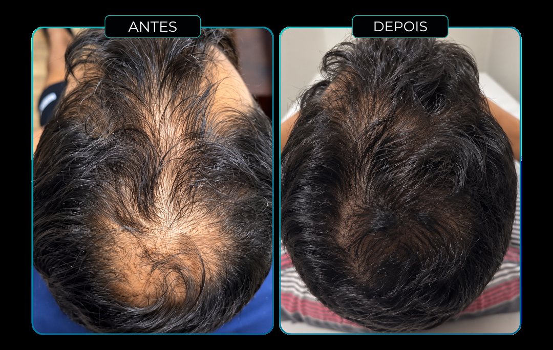 Antes e depois - M Hair